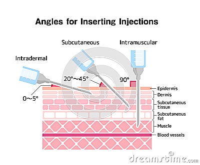 Angles for Inserting Injections vector illustration Vector Illustration