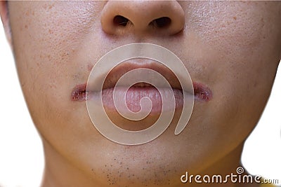 Angular stomatitis or angular cheilitis or perleche in asian man. Mouth ulcer. Common inflammatory condition caused by iron, zinc Stock Photo