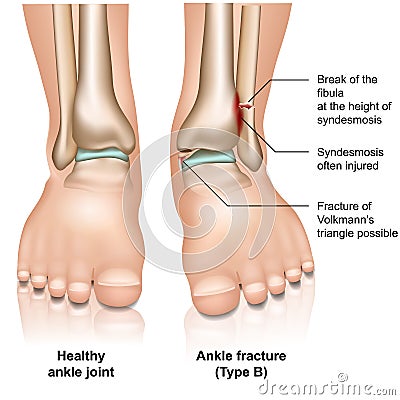 Ankle joint fracture Type B medical illustration on white background Cartoon Illustration