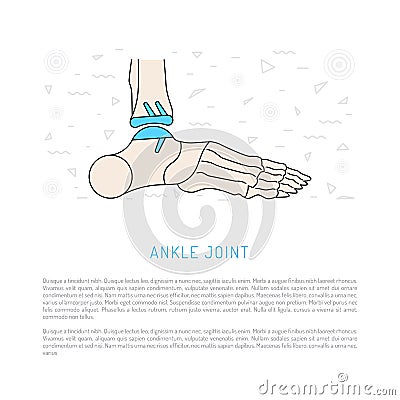 Ankle joint replacement Vector Illustration