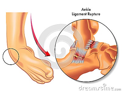 Ankle ligament rupture Vector Illustration