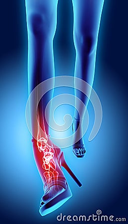 Ankle high heeled painful - skeleton x-ray. Stock Photo