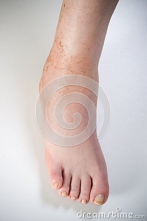 Ankle sprain Stock Photo