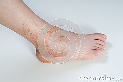 Ankle sprain Stock Photo