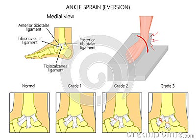 Ankle sprain.Eversion Vector Illustration