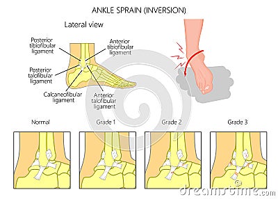 Ankle sprain.Inversion Vector Illustration