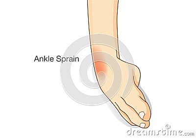 Ankle sprain and swelled. Vector Illustration