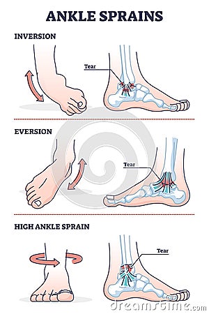 Ankle sprains situations with inversion and eversion injury outline diagram Vector Illustration