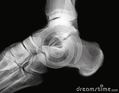 Ankle x-ray Stock Photo