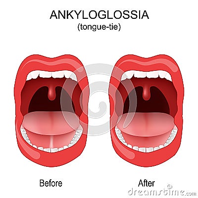 Ankyloglossia. tongue-tie. congenital oral anomaly Vector Illustration