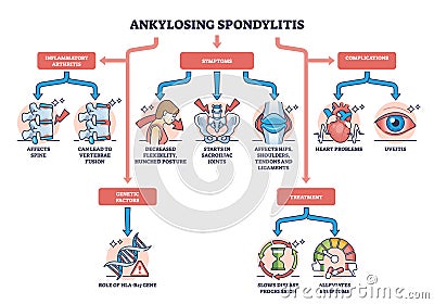 Ankylosing spondylitis as arthritis symptoms or complications outline diagram Vector Illustration