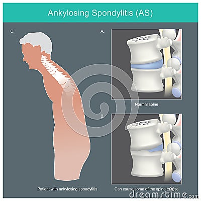 Ankylosing spondylitis. Human spine. Vector Illustration