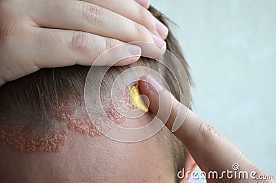 Anoint with cream, ointment, medicine forehead, hair line, scalp with psoriasis, dermatitis, problem skin, eczema Stock Photo