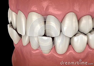 Anterior crossbite dental occlusion Malocclusion of teeth . Medically accurate tooth 3D illustration Cartoon Illustration