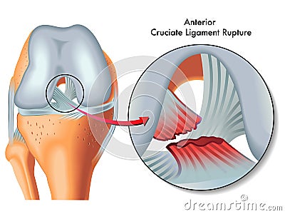 Anterior cruciate ligament rupture Vector Illustration