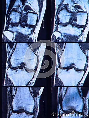 Anterior cruciate ligament tear seen on knee MRI. Stock Photo