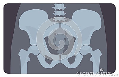 Anterior radiograph of human pelvis or hip bone with lumbar part. X-ray picture or image of human skeletal system, front Vector Illustration