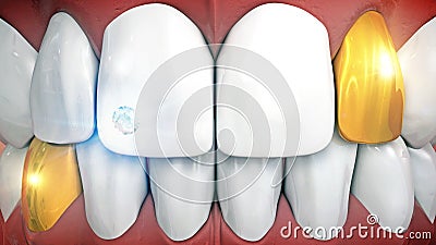 Anterior teeth with gemstone implant and eyeteeth in gold Stock Photo