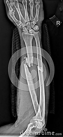 Adult Forearm Fractures -x-ray Anteroposterior Radiograph Stock Photo