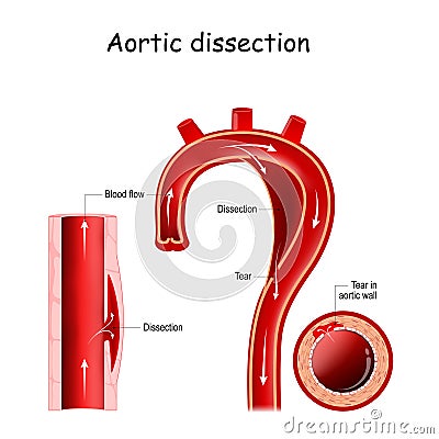 Aortic dissection. longitudinal and cross-section of blood vessel. Vector Illustration