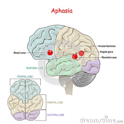 Aphasia. Human Brain with damage to specific areas Vector Illustration