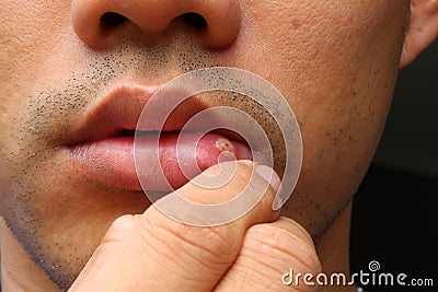 Aphthous stomatitis ,lip leison. asians human face. Stock Photo