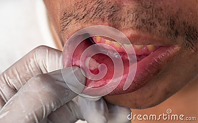 Aphthous ulcer, canker sore or stress ulcer in the mouth Stock Photo