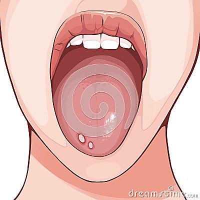 An aphthous ulcer is typically a recurrent round or oval sore or ulcer inside the mouth Cartoon Illustration