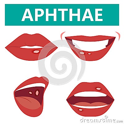 Aphthous ulcers on mouth close up,, vector illustration cartoon flat design clip art Vector Illustration