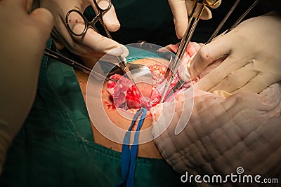 Appendectomy Stock Photo