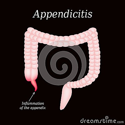 Appendicitis. Inflammation of the appendix. Colon Vector Illustration