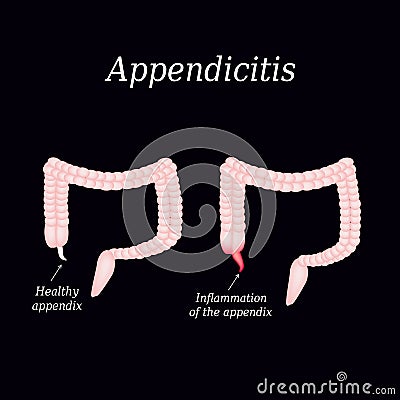 Appendicitis. Inflammation of the appendix. Colon. The illustration on a black background Vector Illustration