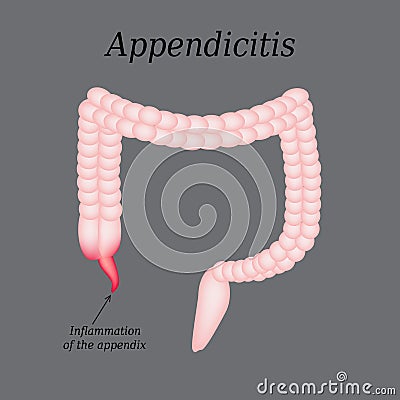 Appendicitis. Inflammation of the appendix. Colon. The illustration on a gray background Vector Illustration