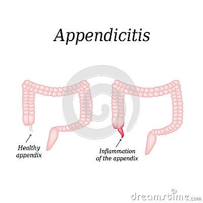 Appendicitis. Inflammation of the appendix. Colon Vector Illustration