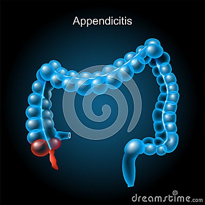 Appendicitis. large intestine on dark background Vector Illustration