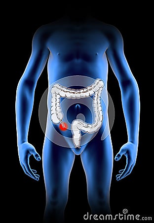 The appendix is a finger-like, blind-ended tube connected to the cecum. The cecum is a pouch-like structure of the colon Stock Photo