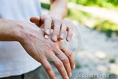 Applying an cream emollient to dry flaky skin as in the treatment of psoriasis, eczema and other dry skin conditions Stock Photo