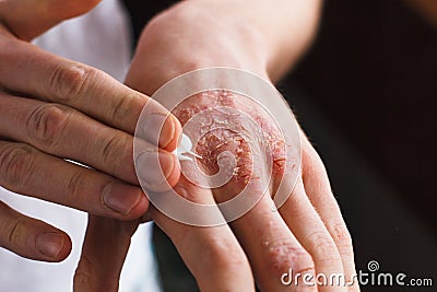 Applying an emollient to dry flaky skin as in the treatment of psoriasis, eczema and other dry skin conditions Stock Photo