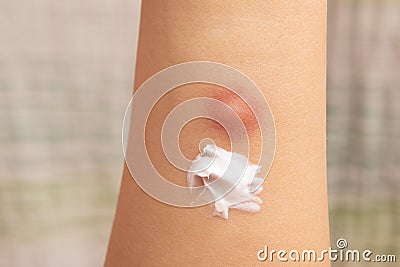 Applying topical antihistamine medicine cream on little boy body with insect bites Stock Photo