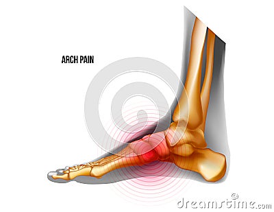 Arch of foot pain bones skeleton realistic anatomy illustration Vector Illustration