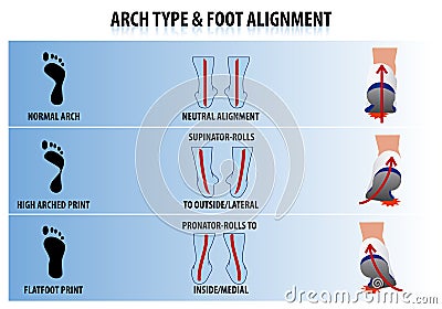 Arch Type and Foot Alignment Vector Illustration