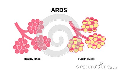 ARDS anatomical poster Vector Illustration