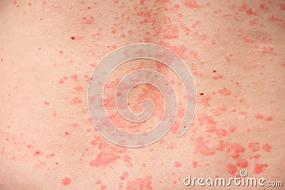 An area of the body covered with an allergic rash, very close-up Stock Photo