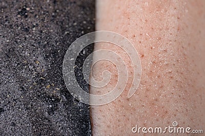 Area of problem skin. Exfoliated cosmetic mask with charcoal that removed acne and cleaned the skin Stock Photo