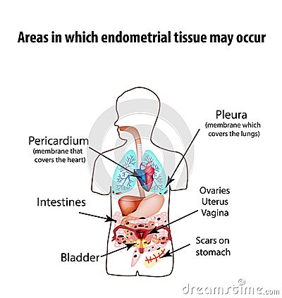 Areas in which endometrial tissue can appear. Endometriosis. Endometriosis in the body. The structure of the lungs Vector Illustration