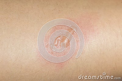 Arm with blister or burn skin Stock Photo