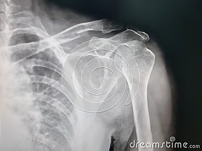 Arm bone xray images blur and noise Stock Photo