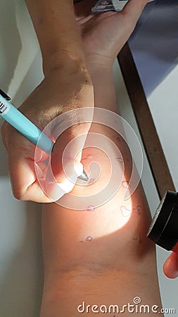 Arm examine with allergy skin prick test rash reaction aero dust mite sensitive Stock Photo