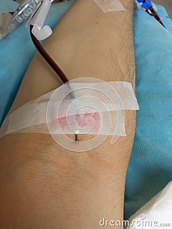 Arm of a man at the hospital when donating blood with the needle Stock Photo
