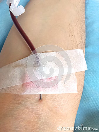 Arm of a man in a hospital during the transfusion of blood with Stock Photo